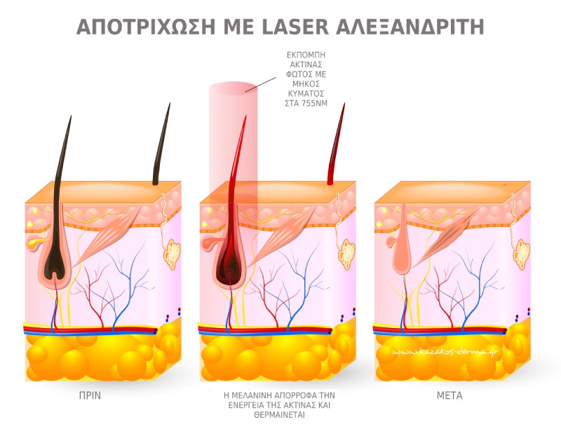 αποτρίχωση, laser Αλεξανδρίτη, kazakos dermatologist, kazakos dermatologos, καλοσ δερματολογοσ αθηνα, καζακοσ δερματολογοσ dermalab, καζακοσ δερματολογοσ, δερματολογοσ κολωνακι, δερματολογοσ συνταγμα, Δερματολογικο κεντρο κολωνακι, οι καλυτεροι δερματολογοι στην αθηνα, καζακος χαρης, δερματολογοσ μετροπολιταν,