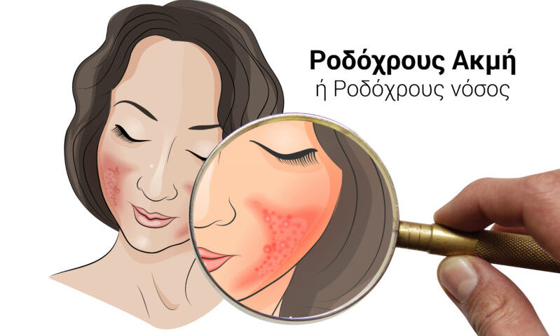 rosacea, icd 10, L71, ροδοχρους ακμή, ροδοχρους νοσος, ροδοχρους ακμή laser, ακμή, κοκκινιλα στο προσωπο, kazakos dermatologist, kazakos dermatologos, καλοσ δερματολογοσ αθηνα, καζακοσ δερματολογοσ dermalab, καζακοσ δερματολογοσ, δερματολογοσ κολωνακι, δερματολογοσ συνταγμα, Δερματολογικο κεντρο κολωνακι, οι καλυτεροι δερματολογοι στην αθηνα, καζακος χαρης, δερματολογοσ μετροπολιταν, δερματολογος
