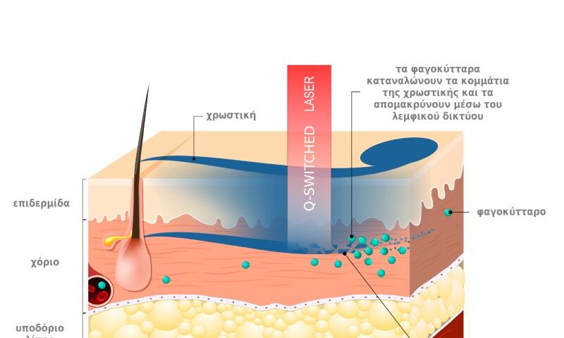 αφαιρεση τατουαζ, pico, τατουάζ, laser, kazakos dermatologist, kazakos dermatologos, καλοσ δερματολογοσ αθηνα, καζακοσ δερματολογοσ dermalab, καζακοσ δερματολογοσ, δερματολογοσ κολωνακι, δερματολογοσ συνταγμα, Δερματολογικο κεντρο κολωνακι, οι καλυτεροι δερματολογοι στην αθηνα, καζακος χαρης, δερματολογοσ μετροπολιταν,