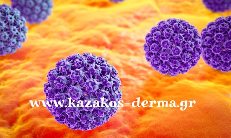 κονδυλώματα, laser για κονδυλώματα, ICD10 A63, kazakos dermatologist, kazakos dermatologos, καλοσ δερματολογοσ αθηνα, καζακοσ δερματολογοσ dermalab, καζακοσ δερματολογοσ, δερματολογοσ κολωνακι, δερματολογοσ συνταγμα, Δερματολογικο κεντρο κολωνακι, οι καλυτεροι δερματολογοι στην αθηνα, καζακος χαρης, δερματολογοσ μετροπολιταν,