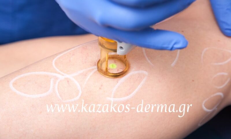 laser για φλέβες, laser, ευρυαγγείες, kazakos dermatologist, kazakos dermatologos, καλοσ δερματολογοσ αθηνα, καζακοσ δερματολογοσ dermalab, καζακοσ δερματολογοσ, δερματολογοσ κολωνακι, δερματολογοσ συνταγμα, Δερματολογικο κεντρο κολωνακι, οι καλυτεροι δερματολογοι στην αθηνα, καζακος χαρης, δερματολογοσ μετροπολιταν,