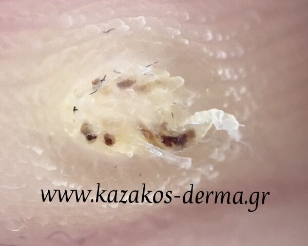 laser για μυρμηκιές, μυρμηγκια, μυρμηκιά, kazakos dermatologist, kazakos dermatologos, καλοσ δερματολογοσ αθηνα, καζακοσ δερματολογοσ dermalab, καζακοσ δερματολογοσ, δερματολογοσ κολωνακι, δερματολογοσ συνταγμα, Δερματολογικο κεντρο κολωνακι, οι καλυτεροι δερματολογοι στην αθηνα, καζακος χαρης, δερματολογοσ μετροπολιταν,