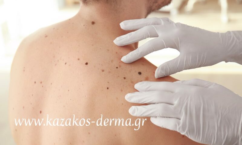 ελιές σώματος, δερματοσκόπηση, χαρτογραφηση, σπιλοι, μελανωμα, kazakos dermatologist, kazakos dermatologos, καλοσ δερματολογοσ αθηνα, καζακοσ δερματολογοσ dermalab, καζακοσ δερματολογοσ, δερματολογοσ κολωνακι, δερματολογοσ συνταγμα, Δερματολογικο κεντρο κολωνακι, οι καλυτεροι δερματολογοι στην αθηνα, καζακος χαρης, δερματολογοσ μετροπολιταν,