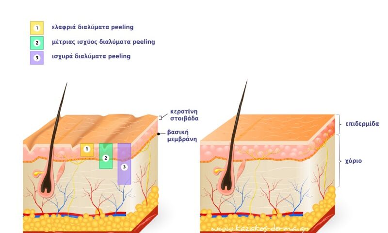 πήλινγκ, χημικο peeling, make-up, peeling, kazakos dermatologist, kazakos dermatologos, καλοσ δερματολογοσ αθηνα, καζακοσ δερματολογοσ dermalab, καζακοσ δερματολογοσ, δερματολογοσ κολωνακι, δερματολογοσ συνταγμα, Δερματολογικο κεντρο κολωνακι, οι καλυτεροι δερματολογοι στην αθηνα, καζακος χαρης, δερματολογοσ μετροπολιταν,