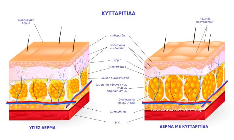 lpg, κυτταρίτιδα, kazakos dermatologist, kazakos dermatologos, καλοσ δερματολογοσ αθηνα, καζακοσ δερματολογοσ dermalab, καζακοσ δερματολογοσ, δερματολογοσ κολωνακι, δερματολογοσ συνταγμα, Δερματολογικο κεντρο κολωνακι, οι καλυτεροι δερματολογοι στην αθηνα, καζακος χαρης, δερματολογοσ μετροπολιταν,
