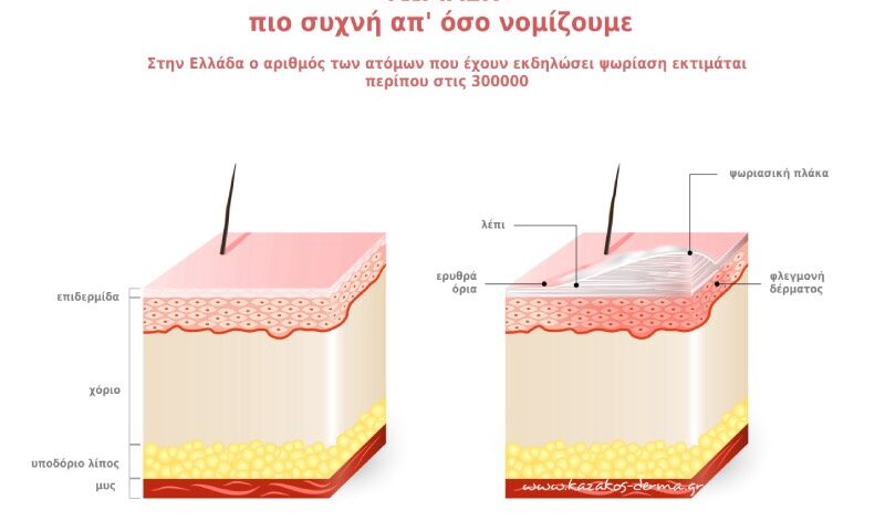 ψωριαση, ψωριασική αρθρίτιδα, ψωριαση στα νυχια,βιολογικοι παραγοντες, δερματολογος καζακος, kazakos dermatologist, kazakos dermatologos, καλοσ δερματολογοσ αθηνα, καζακοσ δερματολογοσ dermalab, καζακοσ δερματολογοσ, δερματολογοσ κολωνακι, δερματολογοσ συνταγμα, Δερματολογικο κεντρο κολωνακι, οι καλυτεροι δερματολογοι στην αθηνα, καζακος χαρης, δερματολογοσ μετροπολιταν,