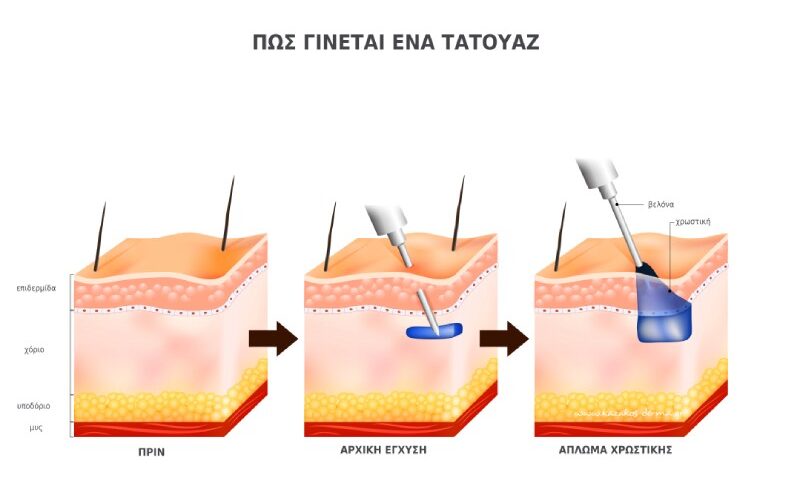 τατουαζ κινδυνοι, τατουάζ, tattoo, laser, kazakos dermatologist, kazakos dermatologos, καλοσ δερματολογοσ αθηνα, καζακοσ δερματολογοσ dermalab, καζακοσ δερματολογοσ, δερματολογοσ κολωνακι, δερματολογοσ συνταγμα, Δερματολογικο κεντρο κολωνακι, οι καλυτεροι δερματολογοι στην αθηνα, καζακος χαρης, δερματολογοσ μετροπολιταν,
