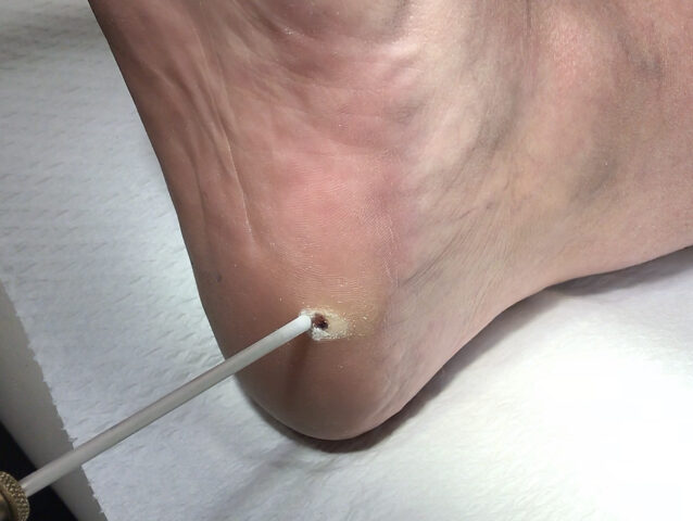 κρυοθεραπεία, κρυοχειρουργική, kazakos dermatologist, kazakos dermatologos, καλοσ δερματολογοσ αθηνα, καζακοσ δερματολογοσ dermalab, καζακοσ δερματολογοσ, δερματολογοσ κολωνακι, δερματολογοσ συνταγμα, Δερματολογικο κεντρο κολωνακι, οι καλυτεροι δερματολογοι στην αθηνα, καζακος χαρης, δερματολογοσ μετροπολιταν,