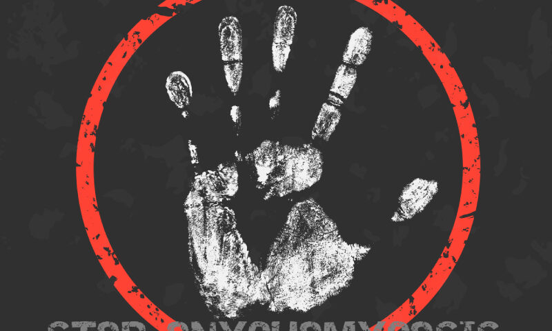 χαλασμενο νυχι, ονυχομυκητιαση, kazakos dermatologist, kazakos dermatologos, καλοσ δερματολογοσ αθηνα, καζακοσ δερματολογοσ dermalab, καζακοσ δερματολογοσ, δερματολογοσ κολωνακι, δερματολογοσ συνταγμα, Δερματολογικο κεντρο κολωνακι, οι καλυτεροι δερματολογοι στην αθηνα, καζακος χαρης, δερματολογοσ μετροπολιταν,