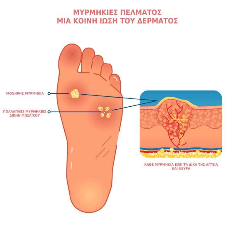 θεραπεια μυρμηγκιων,θεραπεια laser μυρμηγκιες, kazakos dermatologist, kazakos dermatologos, καλοσ δερματολογοσ αθηνα, καζακοσ δερματολογοσ dermalab, καζακοσ δερματολογοσ, δερματολογοσ κολωνακι, δερματολογοσ συνταγμα, Δερματολογικο κεντρο κολωνακι, οι καλυτεροι δερματολογοι στην αθηνα, καζακος χαρης, δερματολογοσ μετροπολιταν,