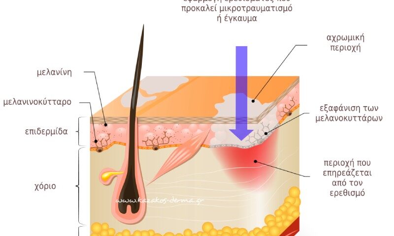 λεύκη, icd10 L80, θεραπεία λεύκης, λεύκη δερματολόγος, τι είναι λεύκη, καζακοσ δερματολογοσ, δερματολογος αθηνα, δερματολογοσ κολωνακι, δερματολογοσ συνταγμα, Δερματολογικο κεντρο κολωνακι, οι καλυτεροι δερματολογοι στην αθηνα, καζακος χαρης, δερματολογοσ μετροπολιταν,