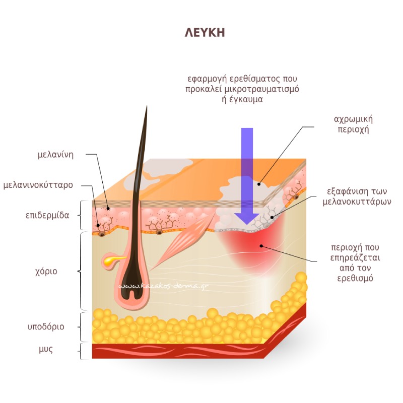 λεύκη, icd10 L80, θεραπεία λεύκης, λεύκη δερματολόγος, τι είναι λεύκη, καζακοσ δερματολογοσ, δερματολογος αθηνα, δερματολογοσ κολωνακι, δερματολογοσ συνταγμα, Δερματολογικο κεντρο κολωνακι, οι καλυτεροι δερματολογοι στην αθηνα, καζακος χαρης, δερματολογοσ μετροπολιταν,