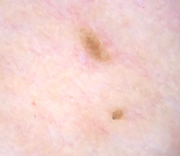 θηλώματα, θηλωματα αιτια, καυτηριασμος θηλωματων, εικονα θηλωματων, θεραπεια θηλωματων, καζακοσ δερματολογοσ, δερματολογος αθηνα, δερματολογοσ κολωνακι, δερματολογοσ συνταγμα, Δερματολογικο κεντρο κολωνακι, οι καλυτεροι δερματολογοι στην αθηνα, καζακος χαρης, δερματολογοσ μετροπολιταν,