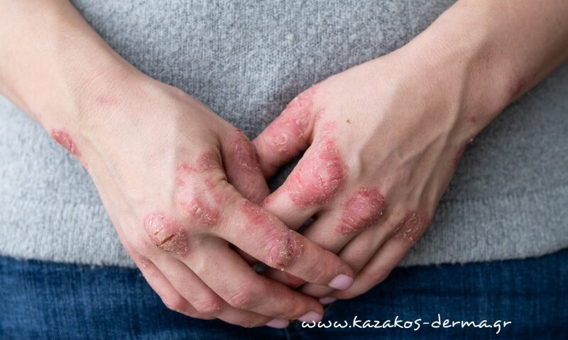 δερματίτιδα εξ επαφής, έκζεμα χεριών, αλλεργική δερματίτιδα, ερεθιστική δερματίτιδα, καζακοσ δερματολογοσ, δερματολογοσ κολωνακι, δερματολογοσ συνταγμα, Δερματολογικο κεντρο κολωνακι, οι καλυτεροι δερματολογοι στην αθηνα, καζακος χαρης, δερματολογοσ μετροπολιταν,