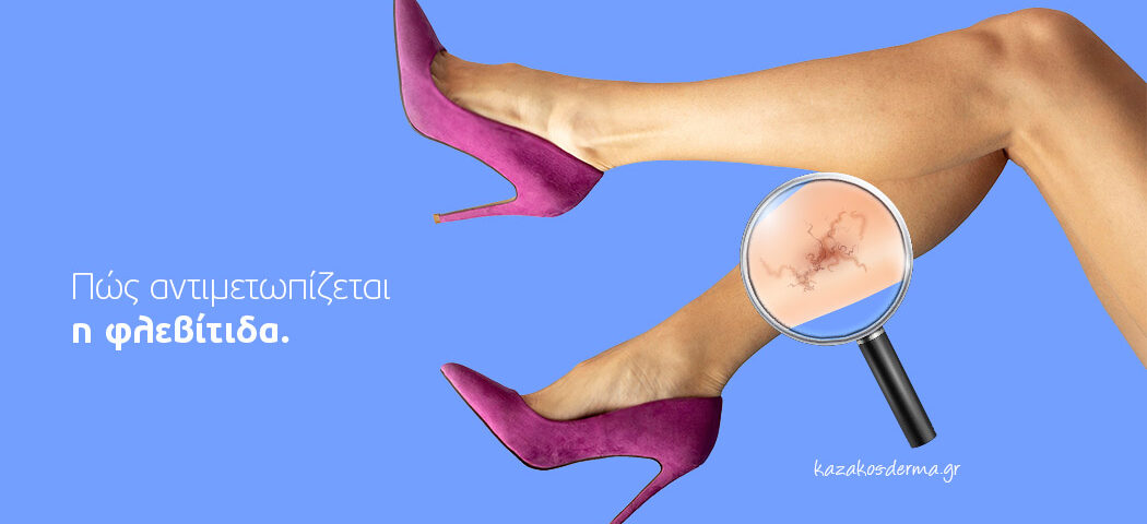 Phlebitis_Article, φλεβίτιδα, κιρσοί